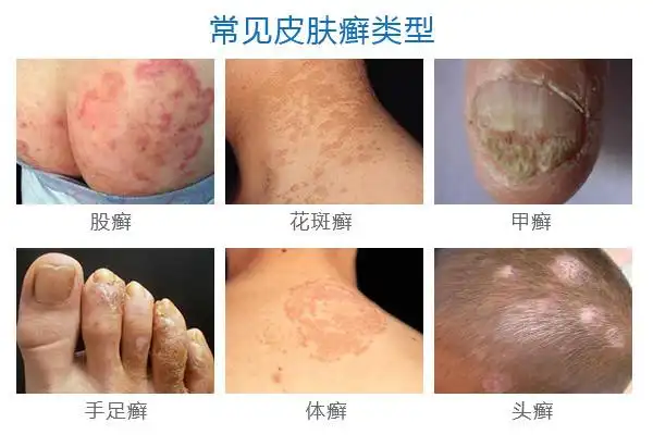 什么是皮肤癣?为何会得癣病?【点击咨询】