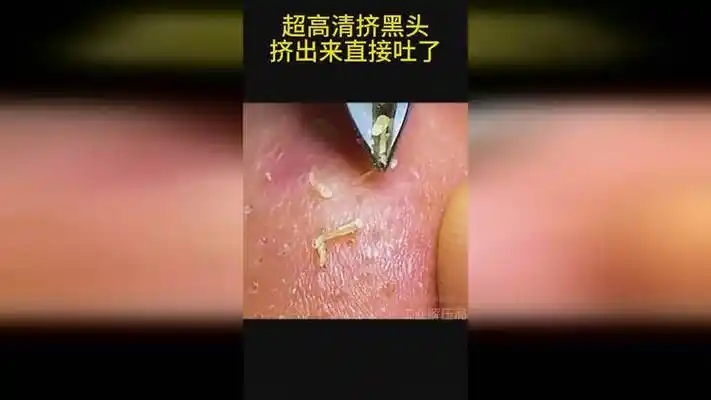 超高清挤黑头挤出来直接吐了!