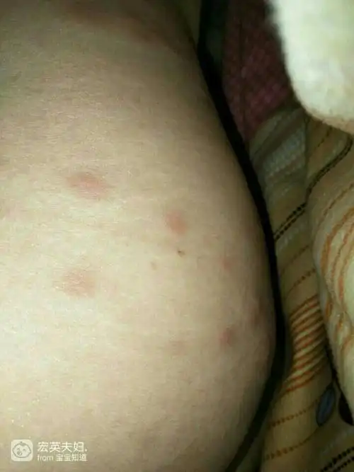 孕晚期了这两天屁股长了好多红色疙瘩特别痒怎么办?