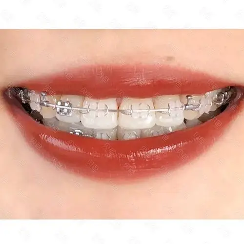 牙套正畸496天可怕的黑三角牙龈又长出来了