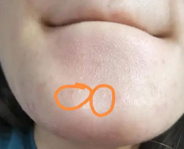 第三种就是下巴上的那种我也说不出来的痘痘.