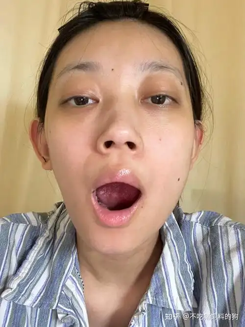 一个颞下颚关节紊乱患者的随笔 - 知乎