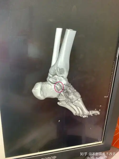 脚踝扭伤一年了,有轻度增生 - 知乎