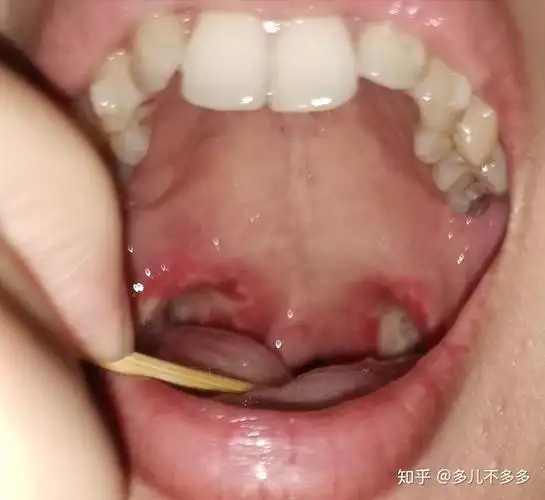 扁桃体切除术低温等离子恢复全过程