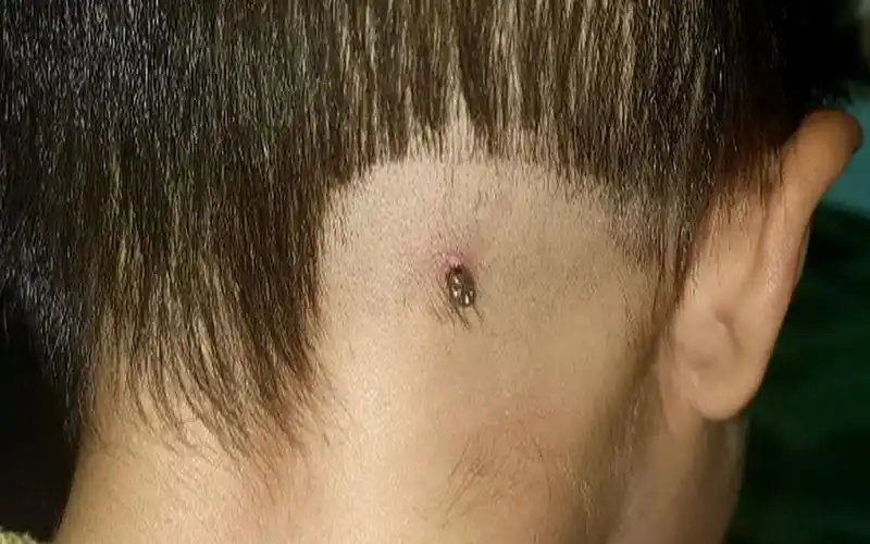 蜱虫叮咬2岁男孩后脑勺,吸血5天,体型暴涨几十倍