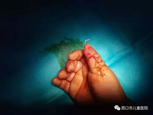 小儿先天性多指畸形多趾畸形手术该什么时间做