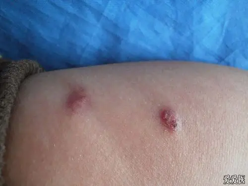 典型病例:孢子丝菌病. - 皮肤及性传播疾病讨论版 - 爱爱医医学论坛