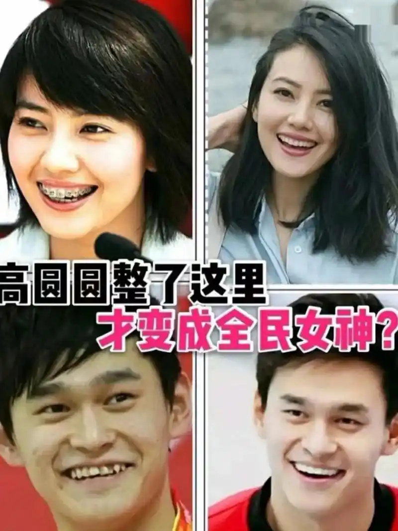 正畸变美  #矫正牙齿 #明星矫正   立马自信起来  颜 - 抖音