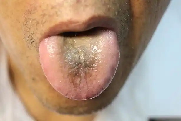 再一个水气外散,水气也是黑色的.凡是舌苔发黑的一定是肾虚了.