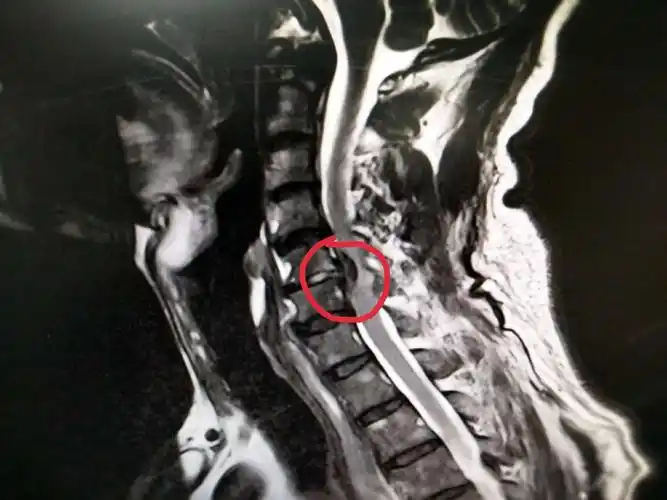 颈椎核磁共振显示颈5-6椎间盘突出,压迫神经,致相应平面椎管