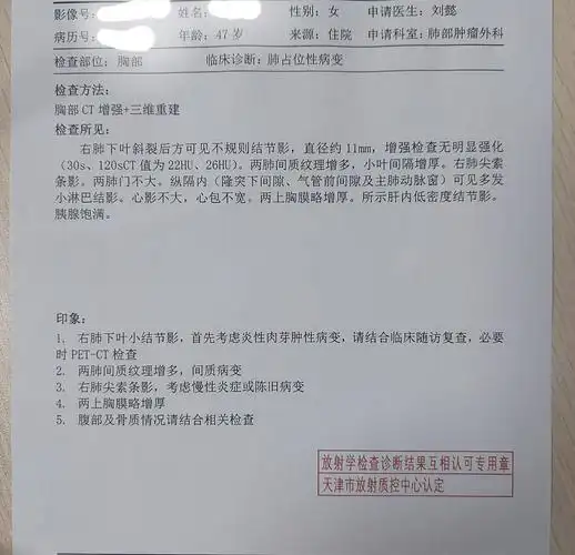 刘懿博士说肺癌一三亖一肺结节ct报告是良性我力主手