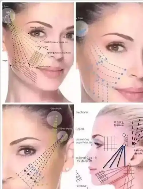 中面部区域:泪沟,苹果肌,法令纹,嘴边赘肉,脸颊下垂等等下面部区域