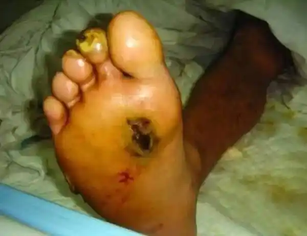 深度烧伤创面的早期处理方法及创面修复