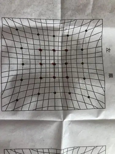 斜视复视检查结果