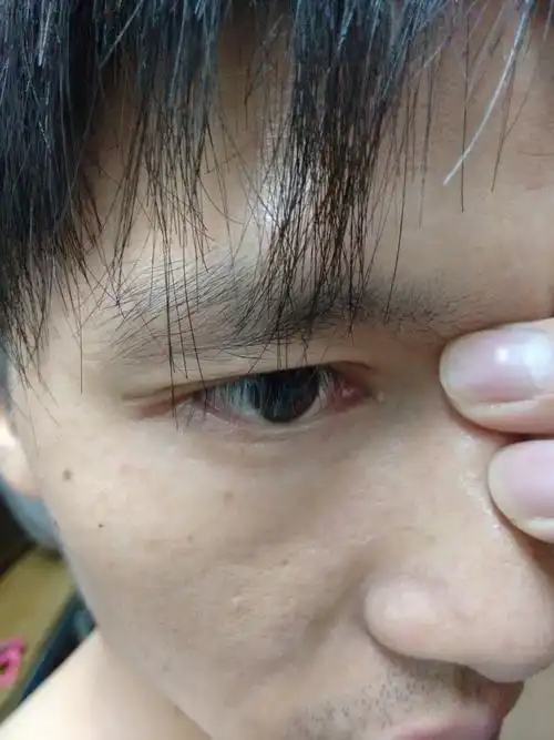 追答: 最好来张图,脂肪粒没事的 不能挤,会很痛,如果你不怕疼,可以挑