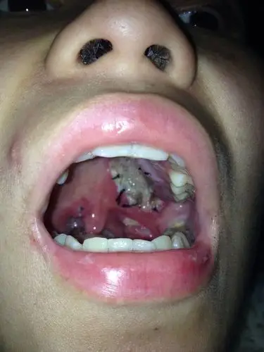 做完上颚肿瘤切除手术,然后纱布掉了,放的