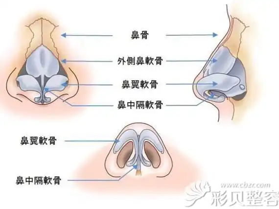 什么样的鼻子适合做鼻骨内推手术呢?