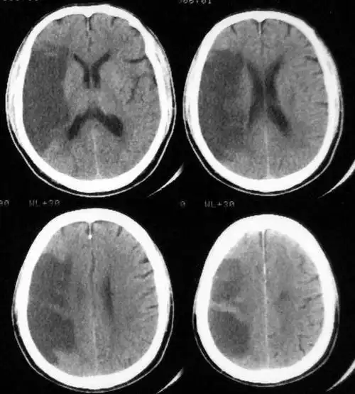 多发性腔隙性脑梗死的临床表现