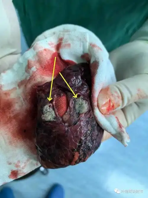 病理示:上叶原位癌,中叶浸润性腺癌,腺泡与贴壁各占50%.