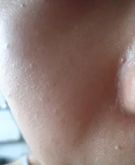 请问我脸上这种小粒粒是什么?怎么能去掉?(图在文字最后面)