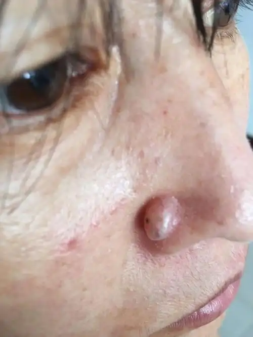 鼻子上硬疙瘩长了三四年了越来越大不疼