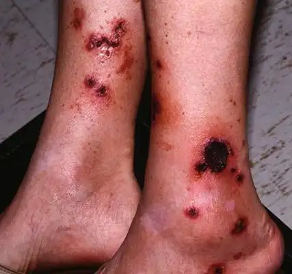 艾滋病发病症状 (61)