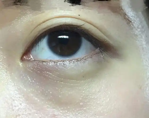 一涂就长脂肪粒,两颗.请问a醇会带来这样的副作用吗