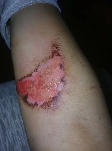 手臂表面被打磨机打伤中间有用过药没有用请问用什么药能够有效的