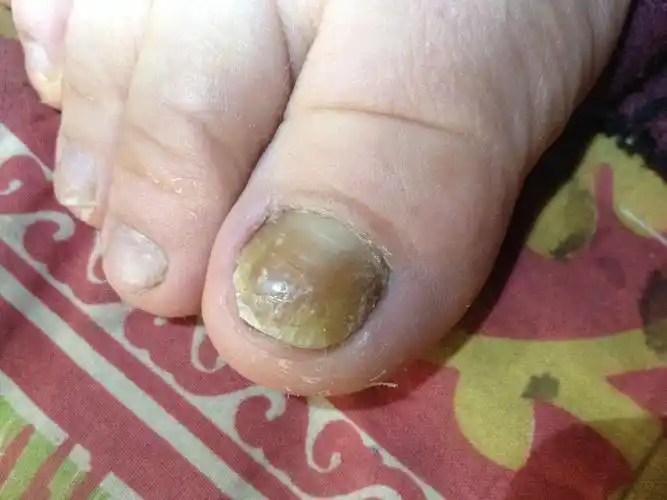 大夫帮帮忙脚指甲得了灰指甲怎么办宝宝刚一岁还在吃奶