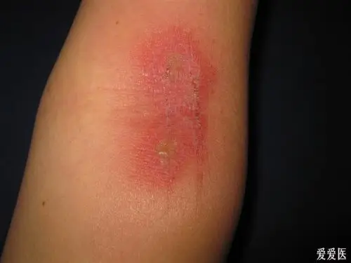 看图识病----------隐翅虫皮炎