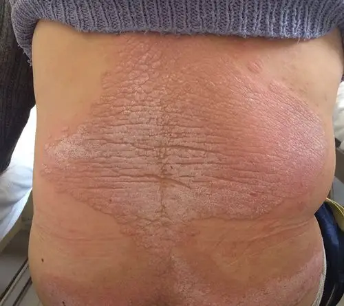 【典型病例】ha280血液灌流疗程化治疗寻常型银屑病(红斑型)1例