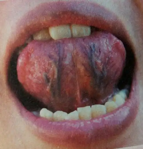 舌下两条静脉又黑又粗,说明这个人体内的瘀血严重