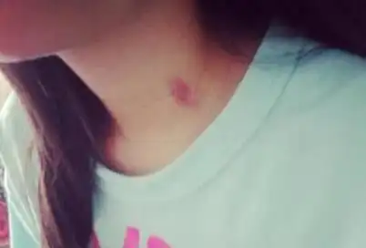 12岁女儿脖子被"种草莓",父亲勃然怒斥,孩子的回答让父母羞愧