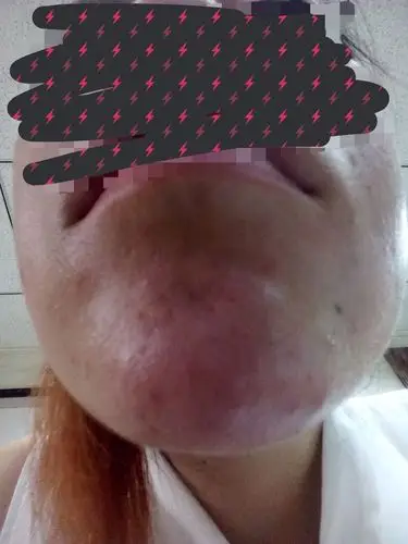 玻尿酸打下巴红肿