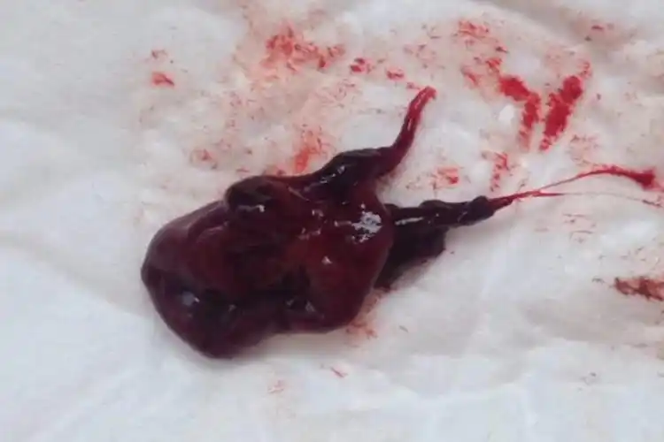 5周流产的胚胎图片