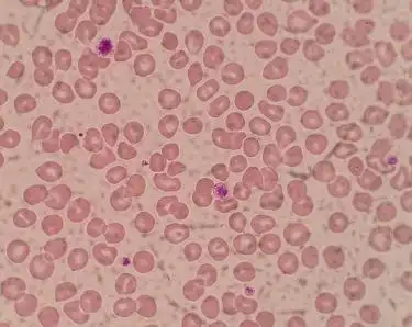 虚惊一场的血小板危急值