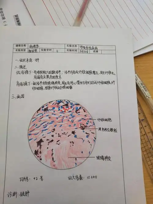 泡沫细胞会由平滑肌细胞和巨噬细胞转化而来,里面有脂类物质,呈空泡状