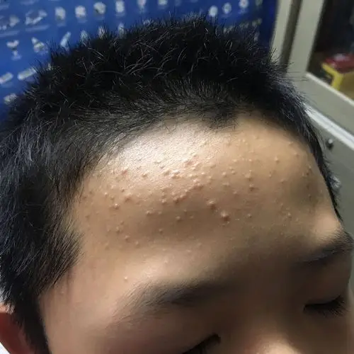 有皮肤科医生在吗 我弟弟10岁 无端端最近额头长满