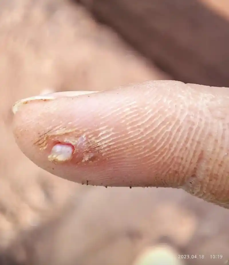 手上长了个肉刺,直接徒手给它拔了,主打的就是一个凶残