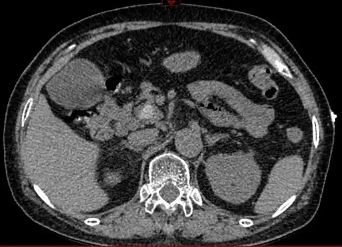 行ct提示胆总管结石并胆道梗阻.(如图3)