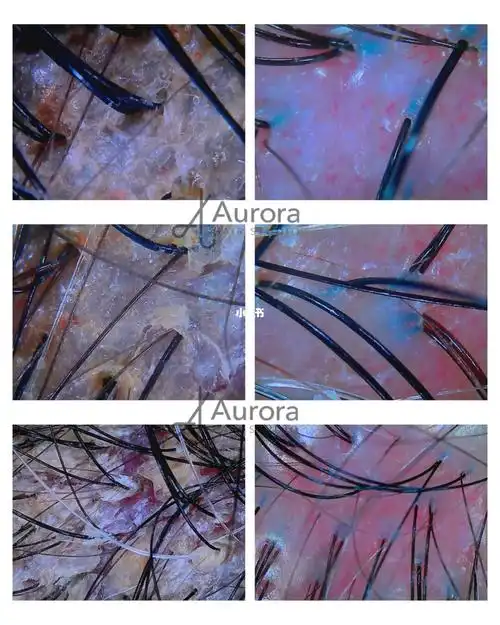 对比图7215效果图会说话护理前9699200倍镜头检测头皮毛囊 是