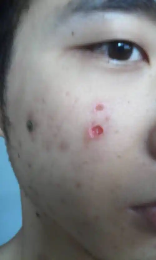 我8天前出水痘,今天下午我睡醒了,看自己的脸黑色掉了的痘坑,不是我抓