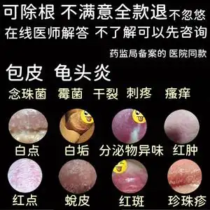 男霉菌性龟头炎包皮消炎膏骚痒念珠菌治疗白垢药膏珍珠疹裂口喷剂