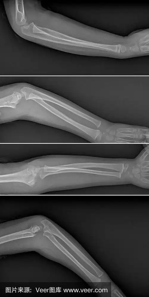 手臂骨折x光