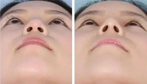 宿迁硅胶延长鼻小柱哪家医院效果比较好价格是多少钱做硅胶延长鼻小柱