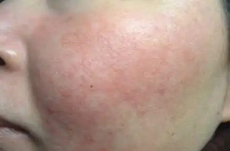 身上出现脂溢性皮炎的症状怎样饮食