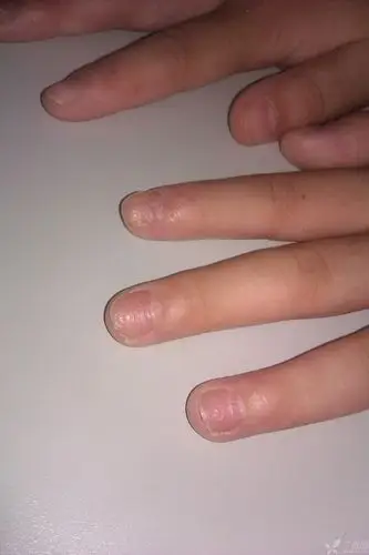 【请教】甲营养不良?有图