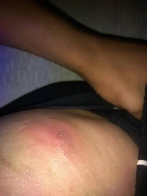 腰上长了一个很大的红包包,并且周围都红肿了,走路都疼,是什么病