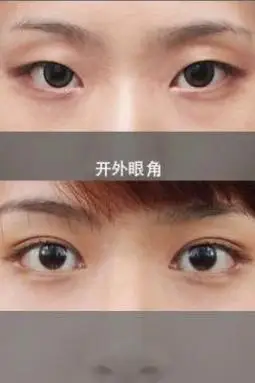 美酱科普:开内眼角和外眼角区别在哪里?你真的搞清楚了吗?
