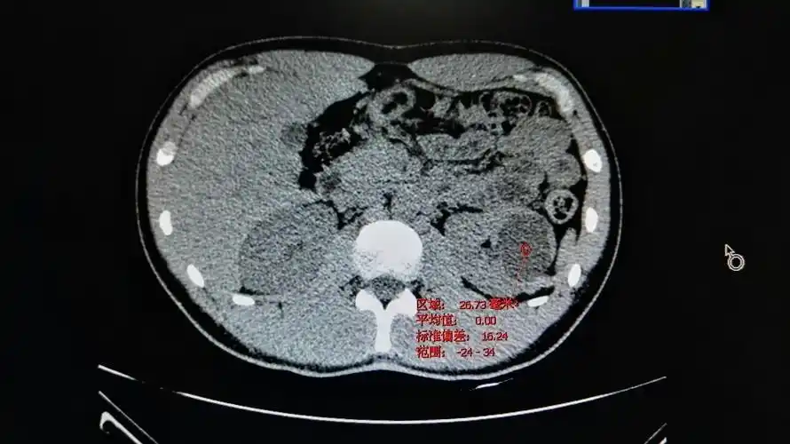 5cm的左肾囊肿,担心军校体检要求治疗,原本水样密度的囊肿增强ct后21